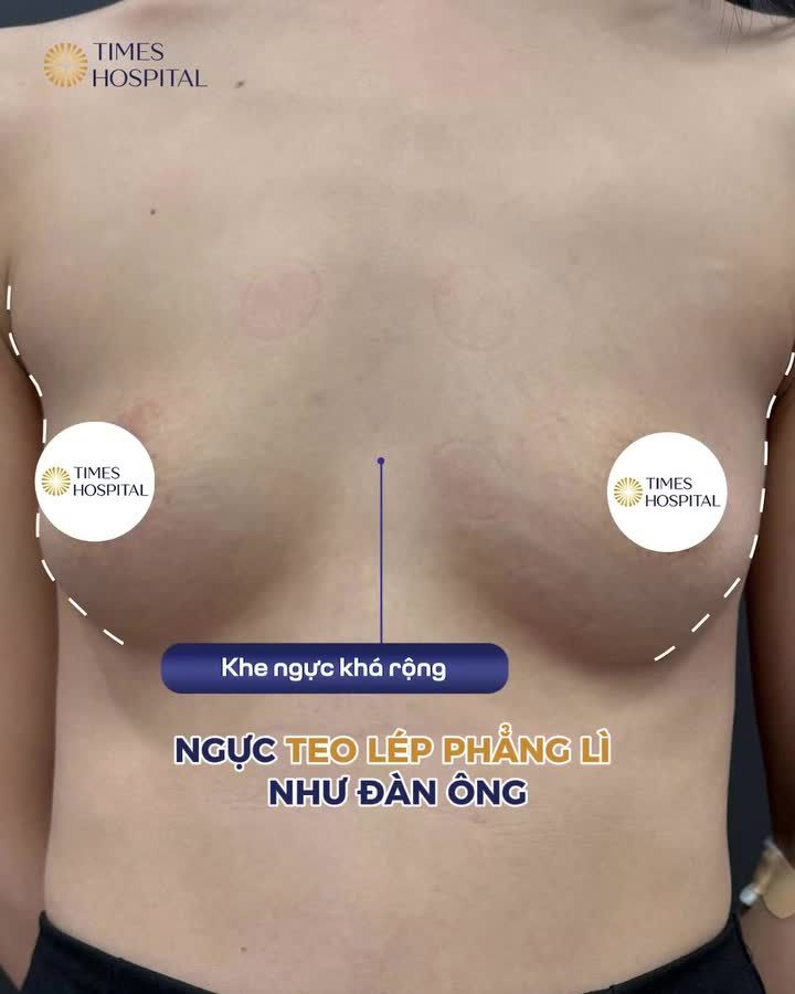 NÂNG NGỰC SAU SINH - CHUẨN TỪNG SỐ CC