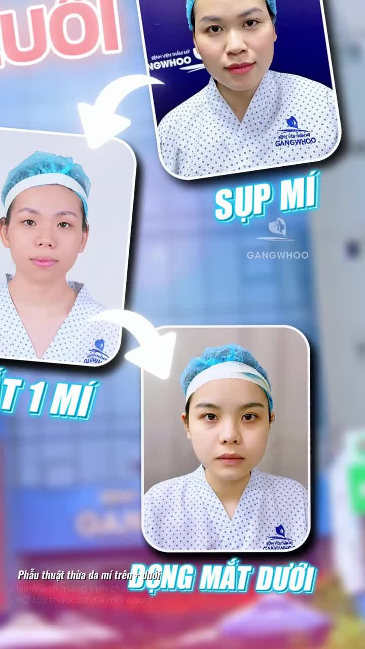 Cắt mí hôm nay - Ưu đãi liền tay