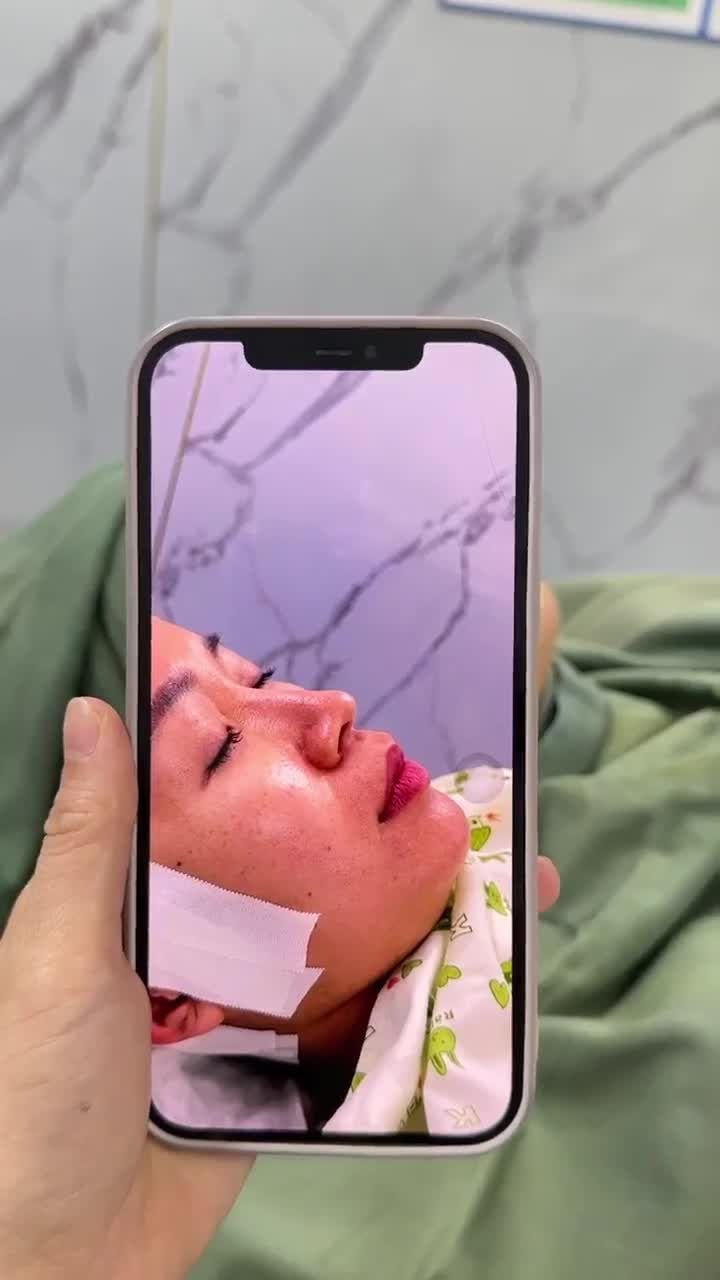 KẾT QUẢ SAU 60 PHÚT NÂNG MŨI CẤU TRÚC - SỬA LẠI MŨI HỎNG | KH. HỒNG THÚY (ĐỒNG NAI)