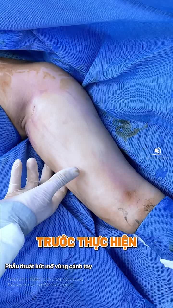 Top 1 cách giải quyết bắp tay to do cơ địa Đến Gangwhoo hút mỡ bắp tay!!!