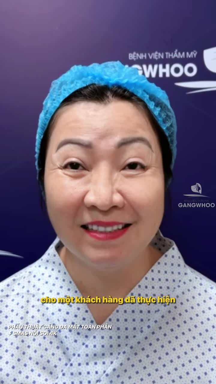 Hành trình tạo ra kết quả hài lòng sau 1 tháng thực hiện phẫu thuật căng da mặt toàn phần + Smas nội soi 4K của Youtuber Việt Kiều Mỹ