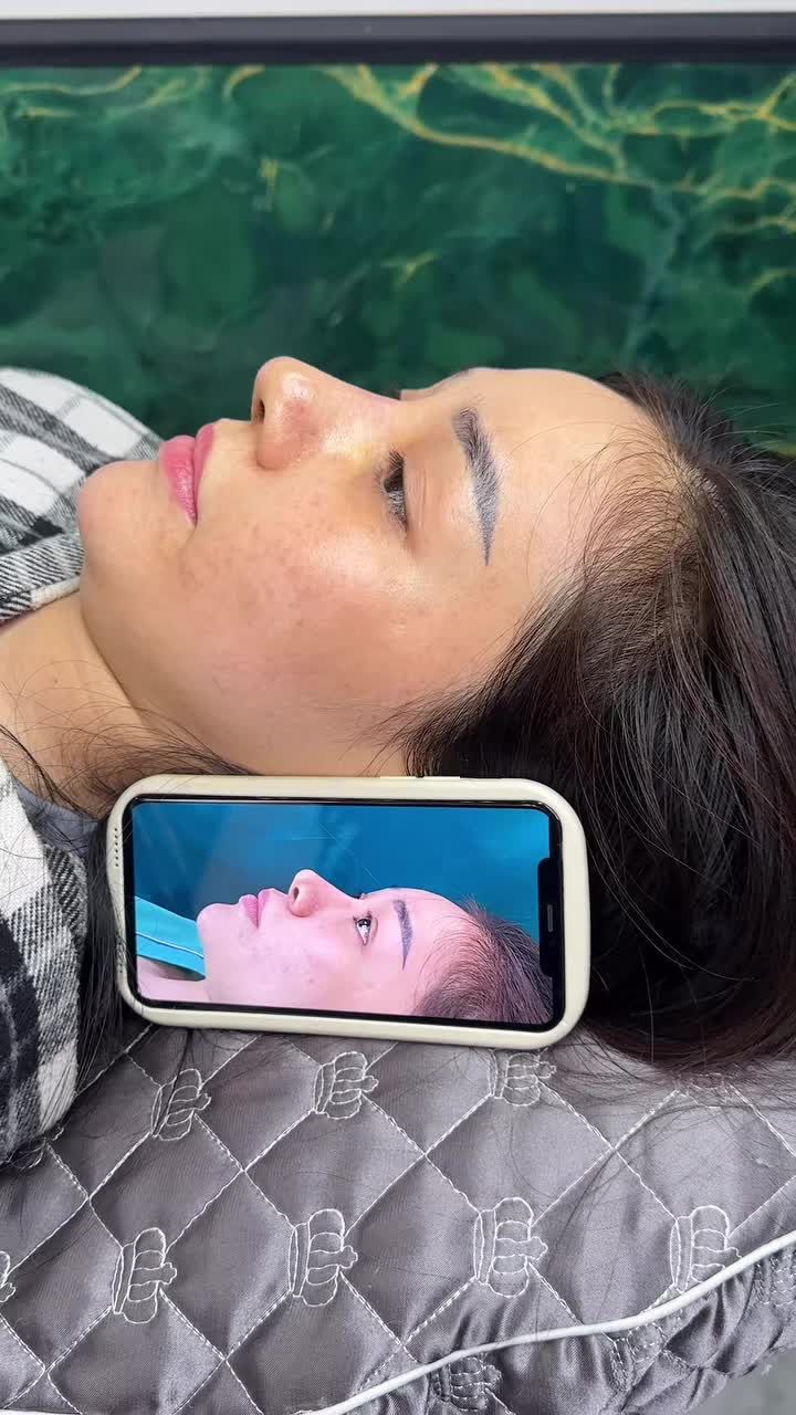 Mũi cấu trúc sửa lại sau 5 ngày