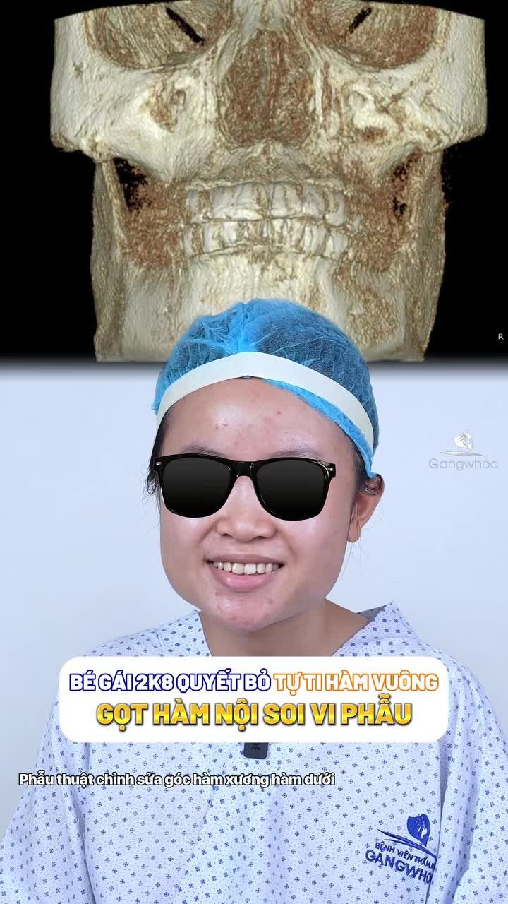 18 năm tự ti với hàm to vuông bạn 2K8 quyết đến Gangwhoo tìm diện mạo mới gọt hàm nội soi vi phẫu