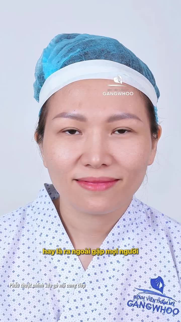 Tự tin với diện mạo sau 1 tháng hạ gò má nội soi vi phẫu tại Bệnh viện thẩm mỹ Gangwhoo