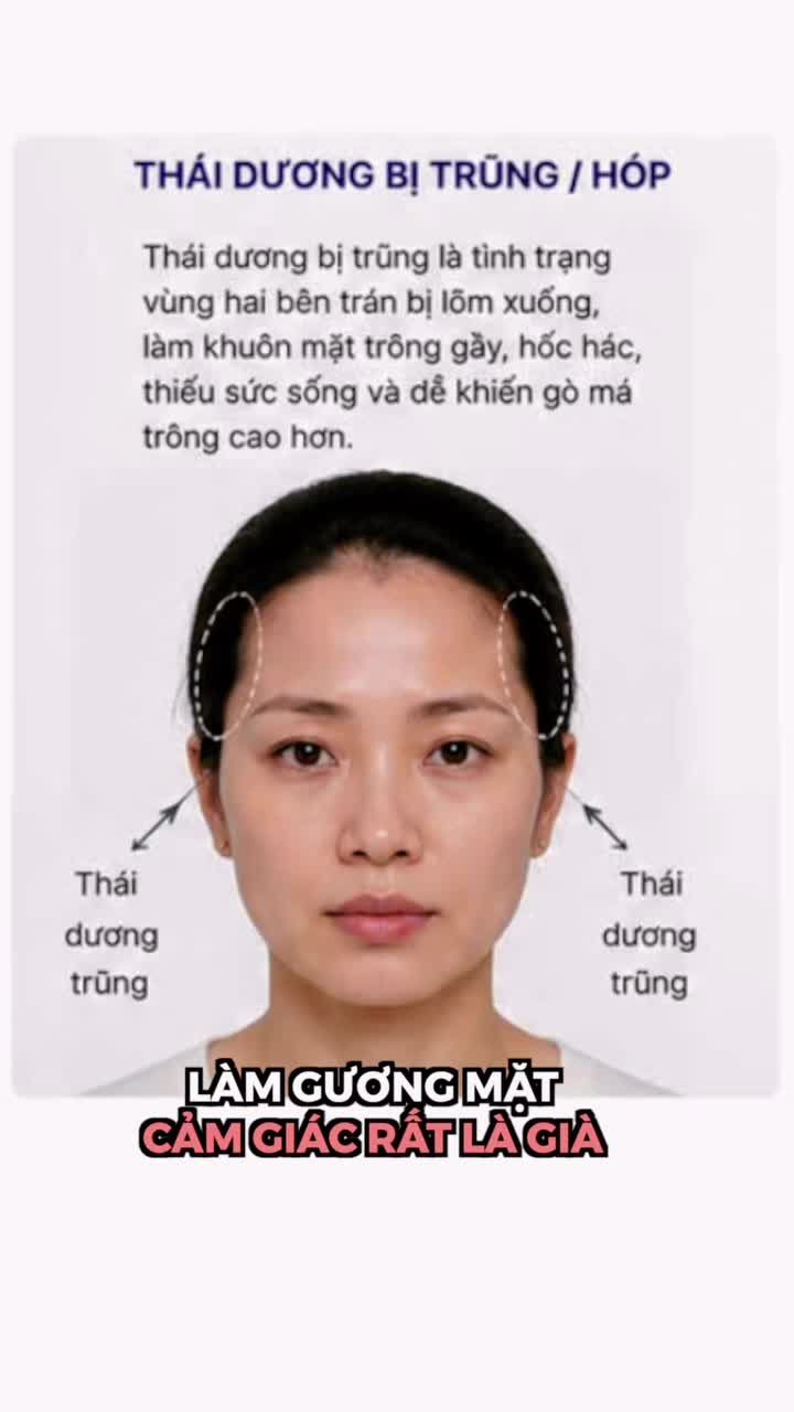 CẤY MỠ THÁI DƯƠNG LỰA CHỌN AN TOÀN HAY ĐÁNH ĐỔI RỦI RO??