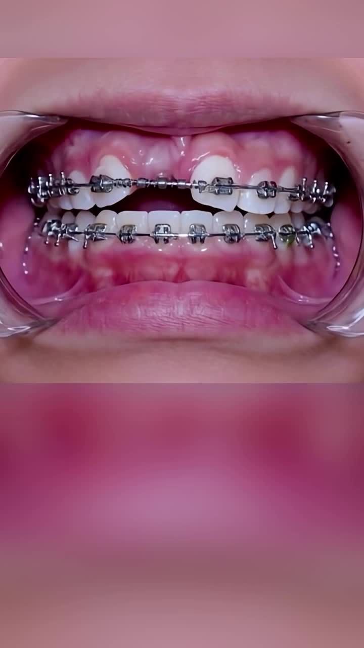 Xử lý răng mọc ngầm khi niềng răng