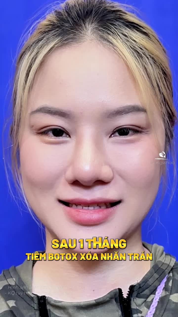 Xóa nhăn trán gì chưa người đẹp?