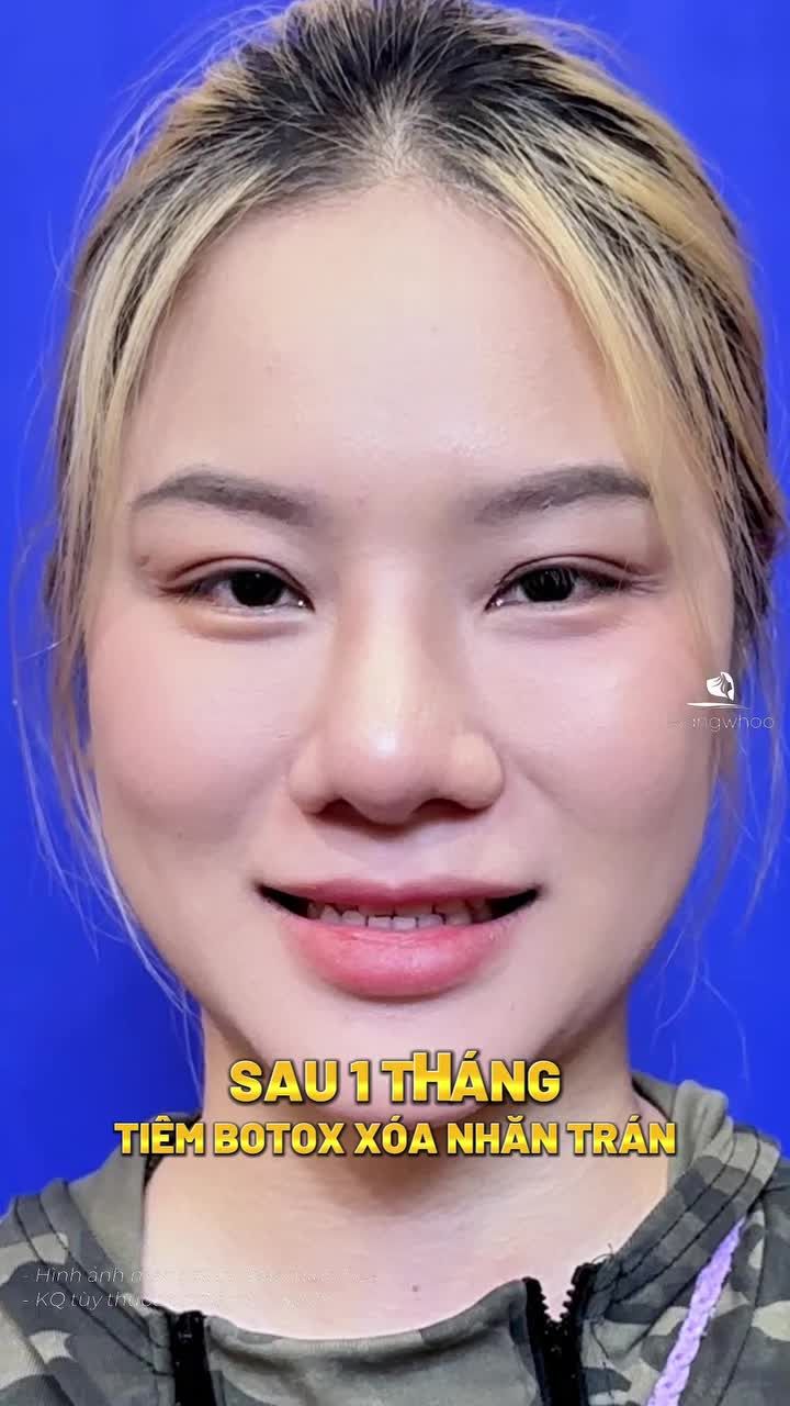 Xóa nhăn trán gì chưa người đẹp?