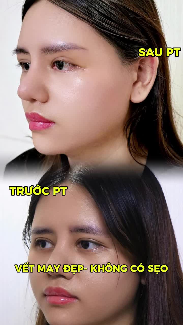 MẶT U BUỒN, MỆT MỎI CHỈ VÌ CUNG MÀY THẤP?