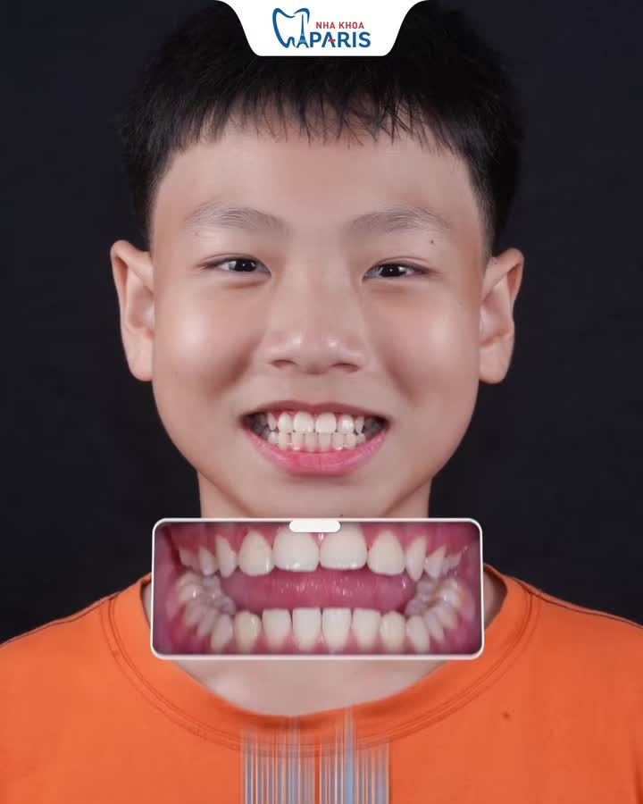 20 THÁNG TẠM BIỆT RĂNG HÔ CHÌA – LỘT XÁC THÀNH SOÁI CA SAU NIỀNG RĂNG!