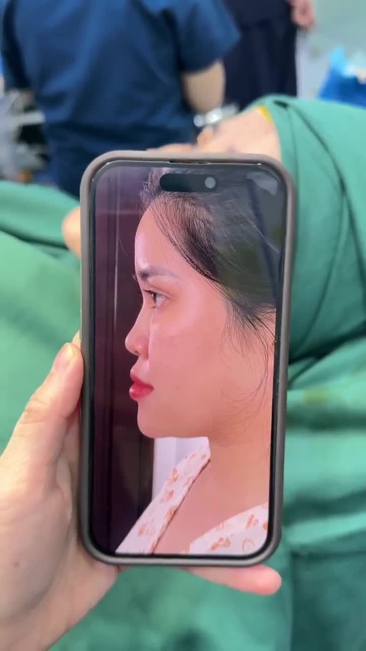 TRẢ KẾT QUẢ NÂNG MŨI NGAY SAU PHẪU THUẬT