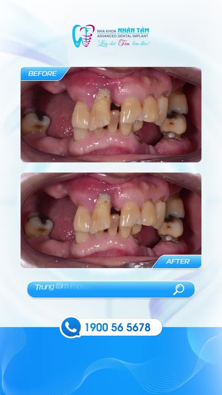 Ba mẹ vẫn nói "ăn được". Nhưng nếu đây là hàm răng của ba mẹ, bạn có thực sự yên tâm?