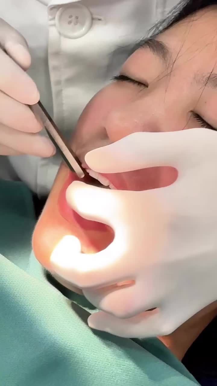 Mất răng số 6 không chỉ gây khó khăn khi ăn nhai mà còn khiến răng số 7, số 8 bị đổ, làm xô lệch toàn bộ hàm.