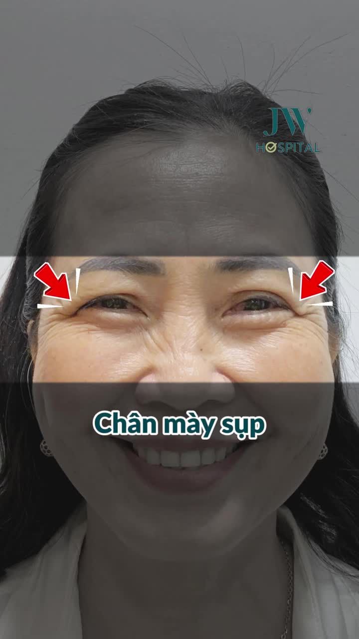 CHỊ EM U40-80 LÃO HÓA SỤP MÍ, CHÂN MÀY SA TRỄ? TREO CHÂN MÀY SẸO VÔ HÌNH TẠI JW GIÚP TRẺ RA 10 TUỔI
