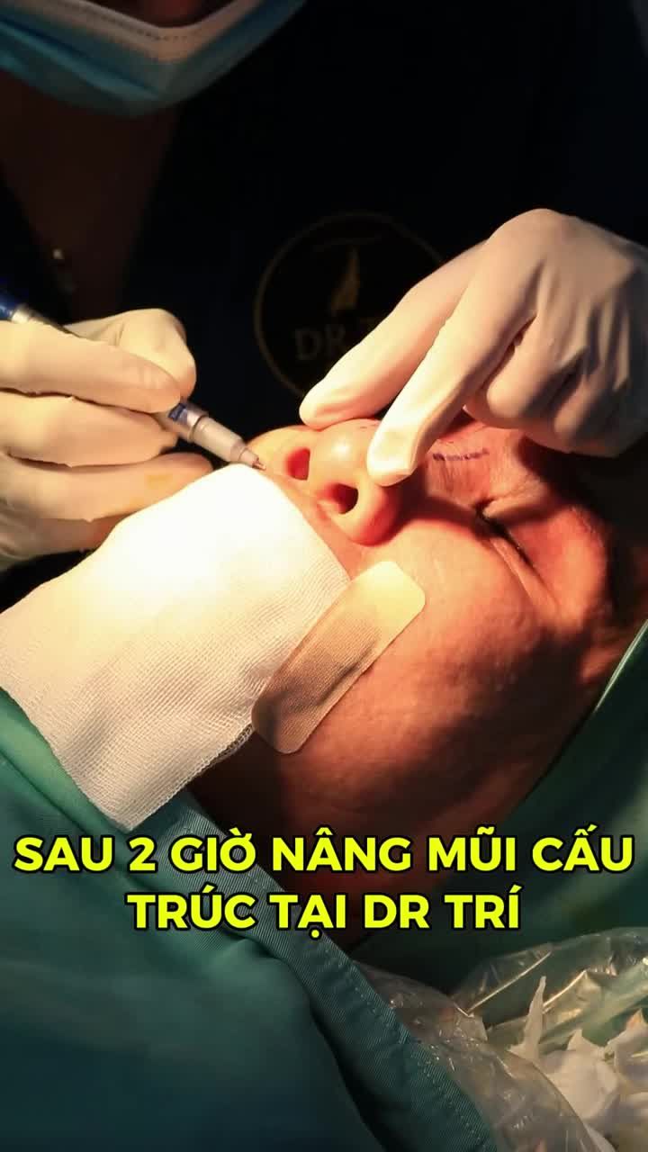 NÂNG MŨI CẤU TRÚC DR TRÍ – TẠO FORM MŨI HÀI HÒA TỰ NHIÊN
