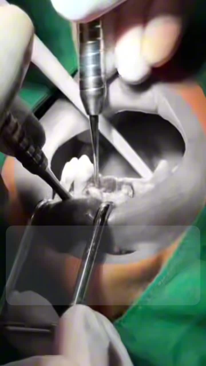 IMPLANT LÂU NĂM BỊ VIÊM NƯỚU – CÓ PHẢI ĐÃ ĐẾN LÚC THAY IMPLANT?