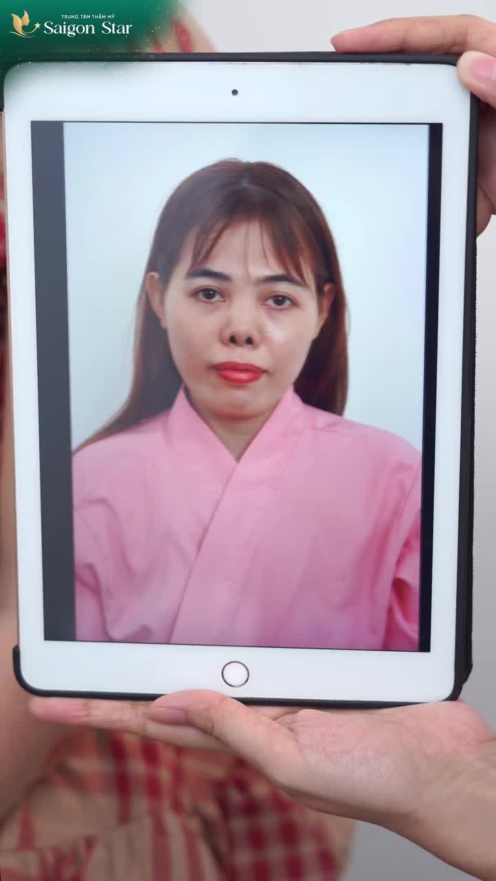 LỖ MŨI KÍN - ĐẦU MŨI TRÒN ĐẦY - FORM MŨI CAO BAY CHÍNH LÀ KẾT QUẢ CỦA QUÁ TRÌNH NỖ LỰC KHẮC PHỤC SỬA LẠI MŨI HỎNG CỦA EKIP BÁC SĨ HOẠT