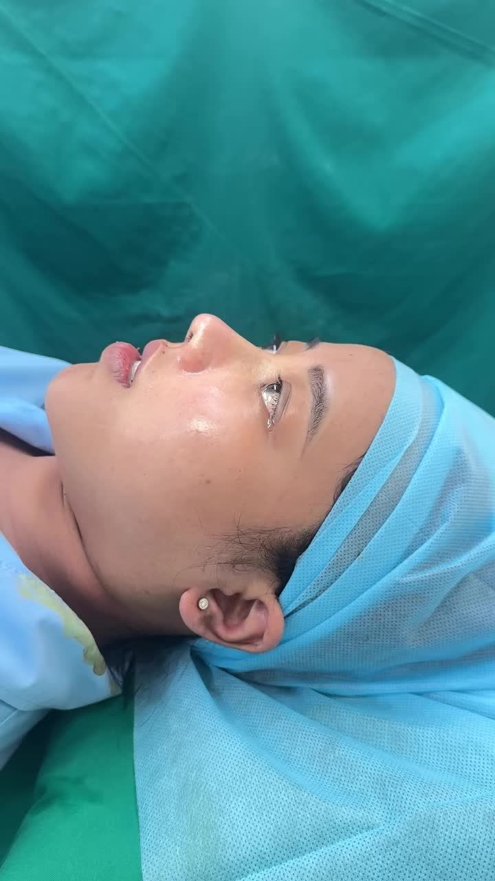 Mũi cấu trúc sau phẫu thuật