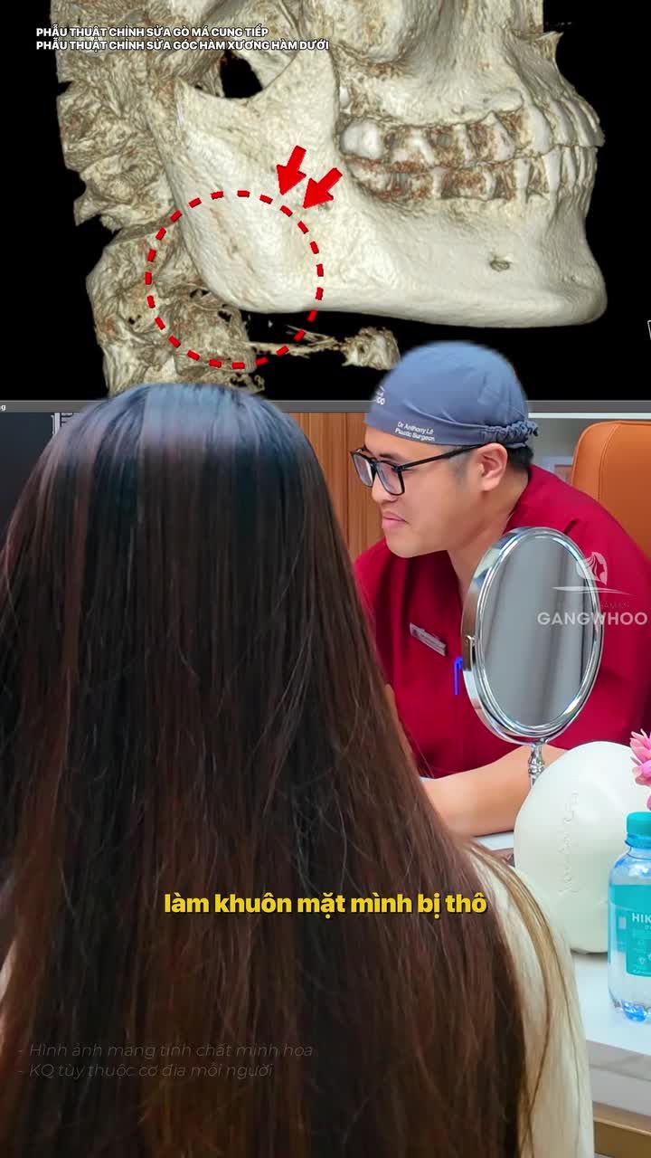 Một góc hàm chuẩn đẹp được bác sĩ Bệnh viện thẩm mỹ Gangwhoo thực hiện như thế nào?