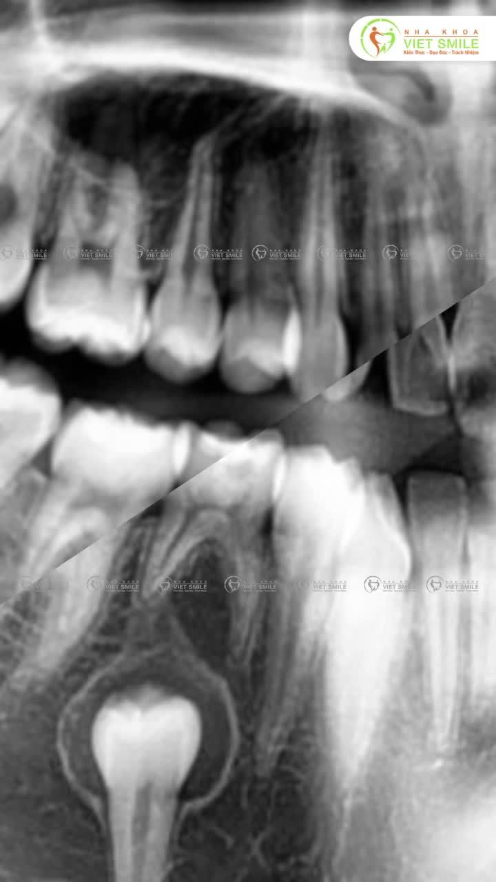 Chỉ cần bạn đến, Viet Smile sẽ giúp bạn xử lý mọi tình trạng răng