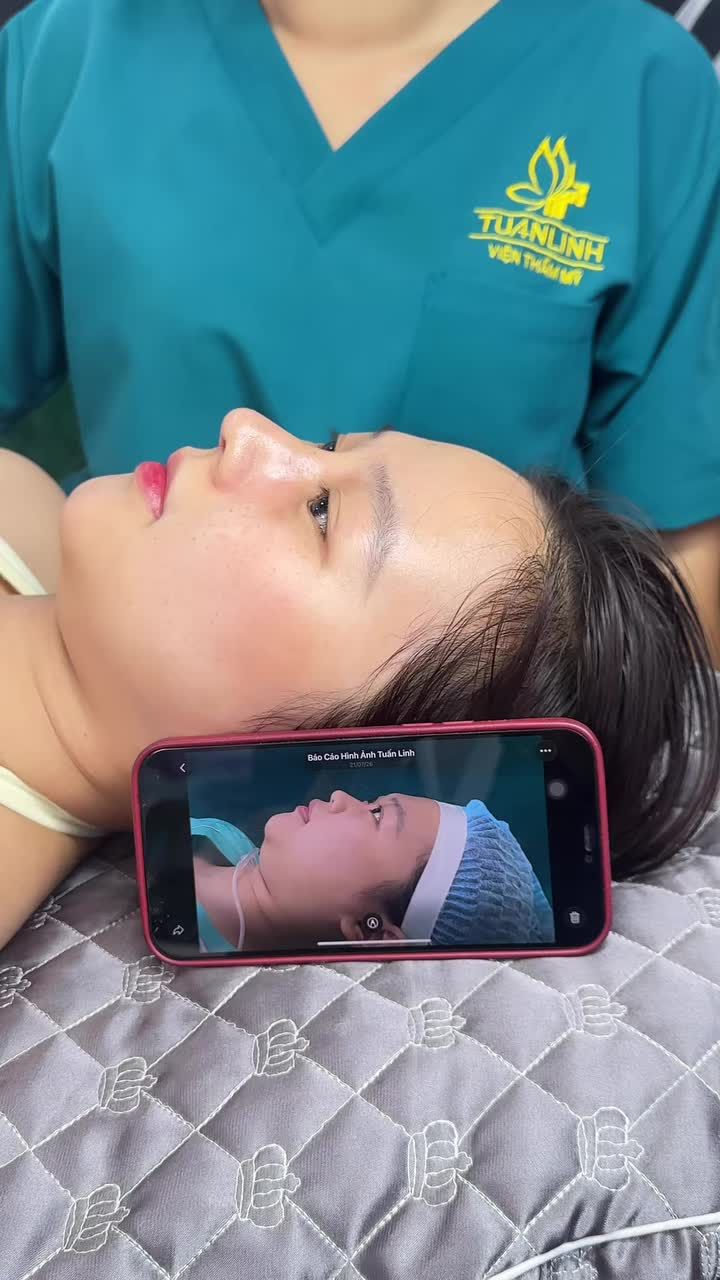 Mũi cấu trúc sau 10 ngày