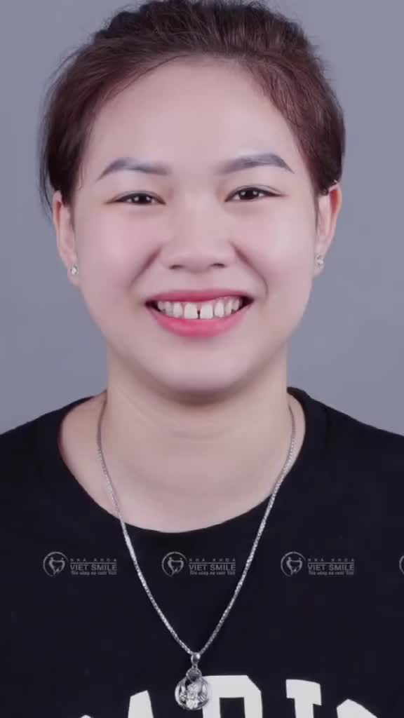 Dán sứ Veneer khắc phục tình trạng răng thưa