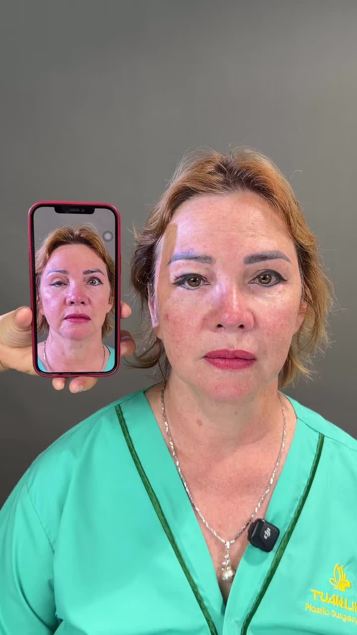 Điều trị nhược cơ mí
