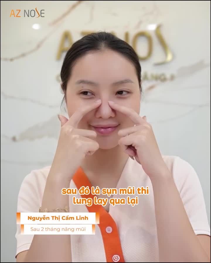 Từng nâng mũi 3 lần nhưng vẫn gặp tình trạng lộ sóng, tụt sụn và sóng mũi lung lay.