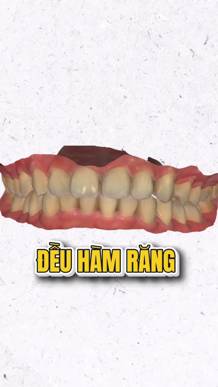 MUỐN GIẢM HÔ NHƯNG CẰM ĐÃ LÙI – KÉO RĂNG THẾ NÀO CHO HỢP LÝ?