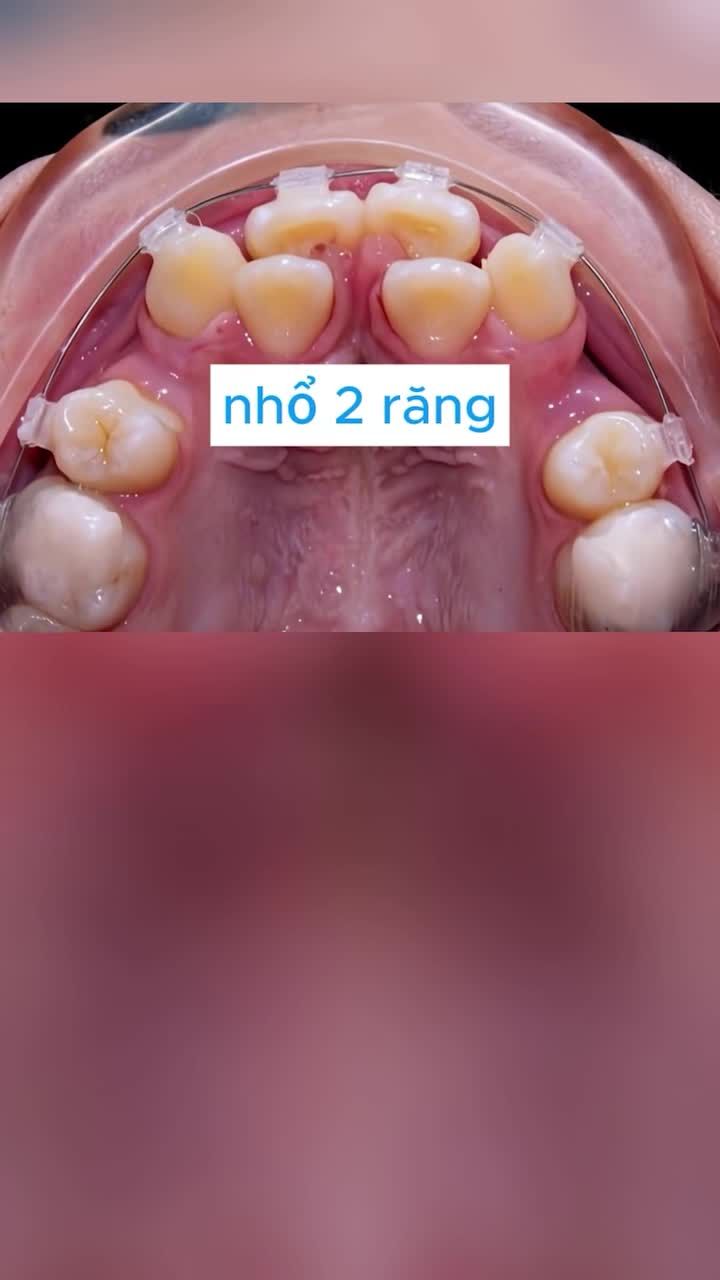 Một ca niềng cần nhổ răng
