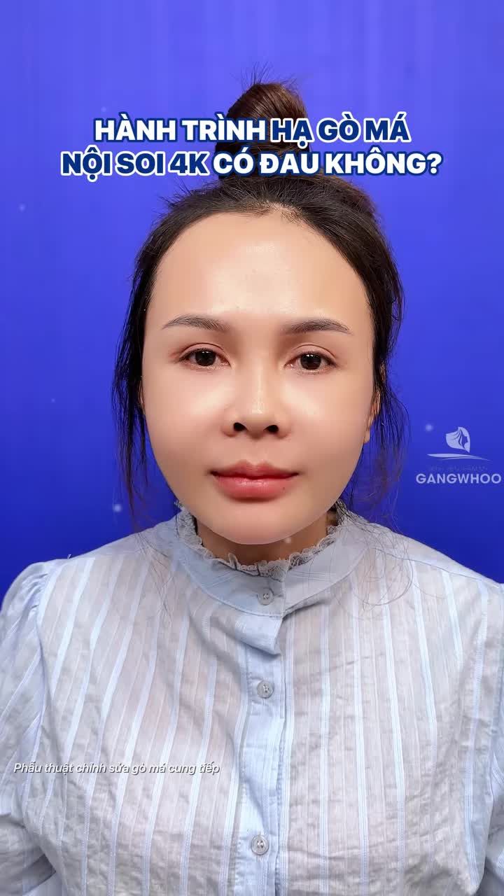 Hành trình hạ gò má có sử dụng nội soi 4K không đau - hài lòng với kết quả sau 10 ngày làm đẹp.