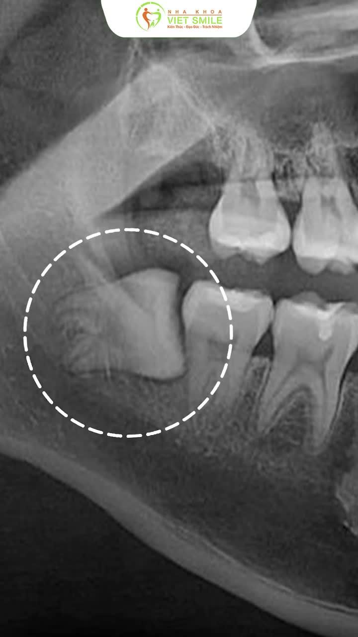 Răng khôn mọc lệch – đừng đợi đến khi đau mới xử lý!
