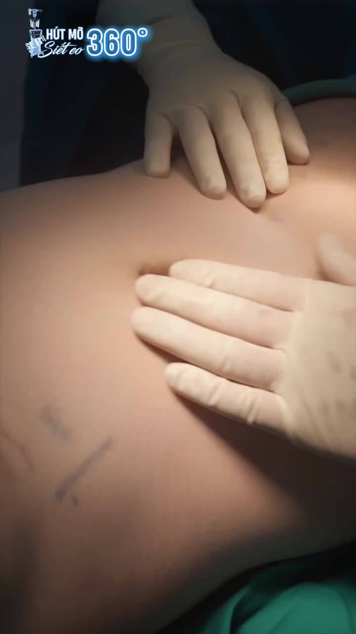 FEEDBACK SAU 1 THÁNG HÚT MỠ BỤNG VASER LIPO