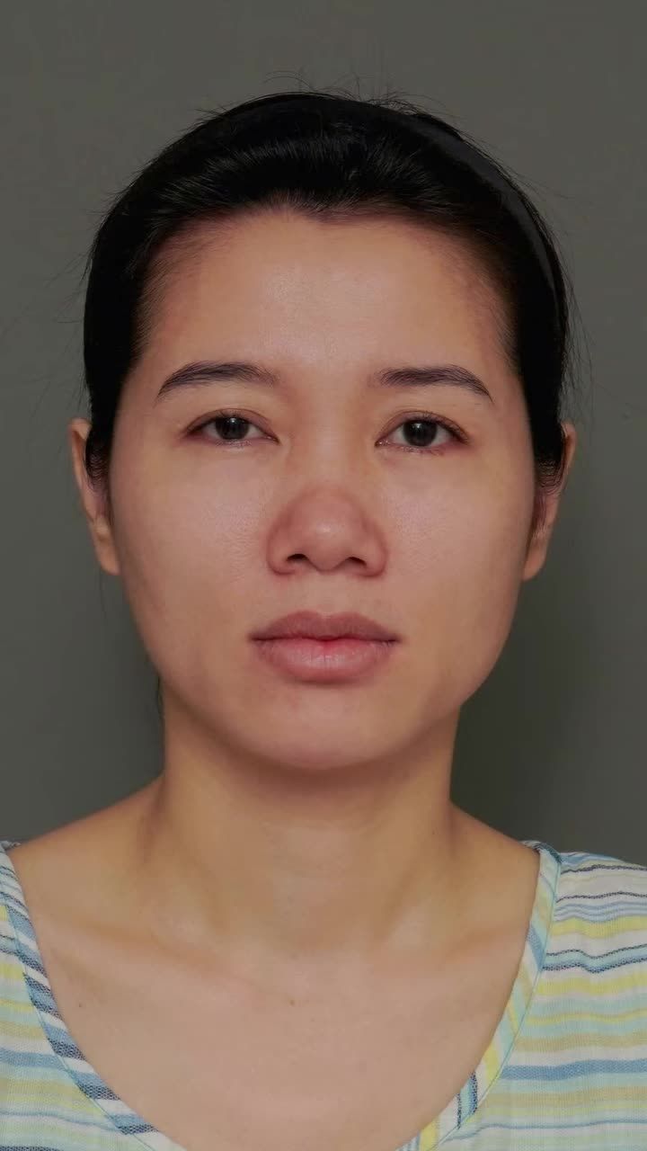 Nhan sắc thăng hạng sau khi nâng mũi Tiny Point - c.ấy m.ỡ cằm! Nhìn là mê