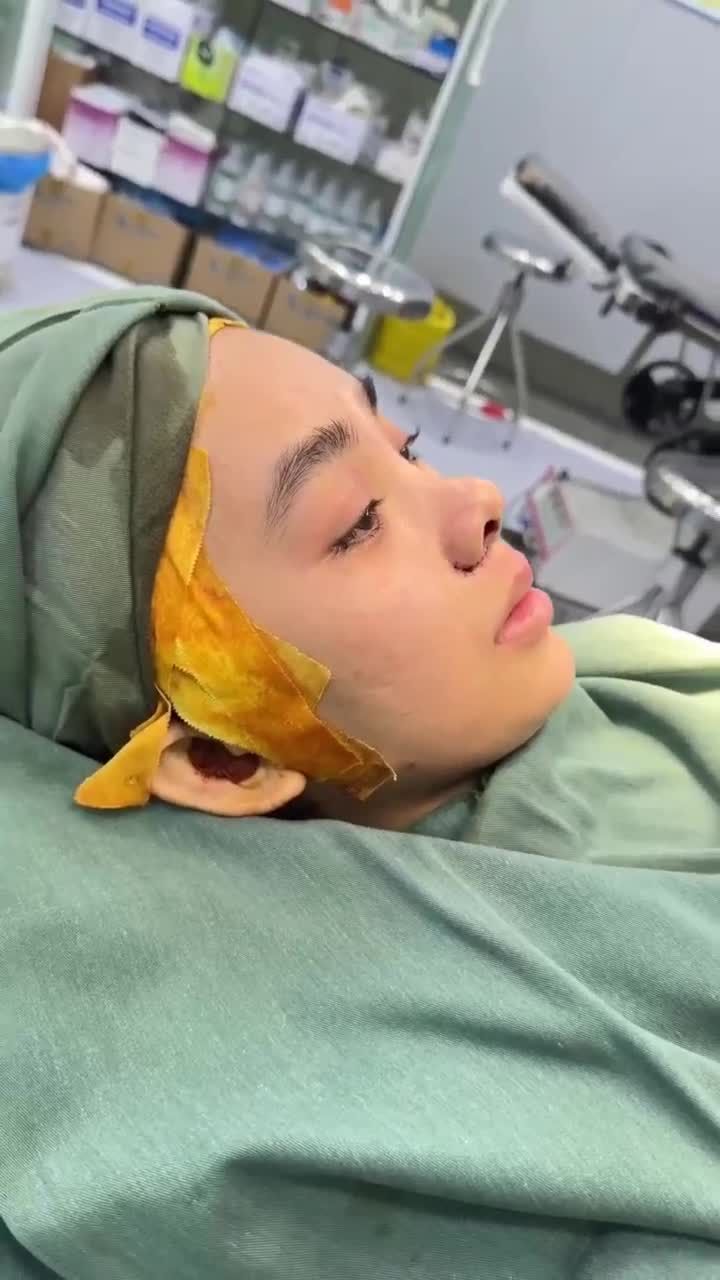 KẾT QUẢ NÂNG MŨI CẤU TRÚC + CẮT CÁNH MŨI KH. NHƯ NGỌC