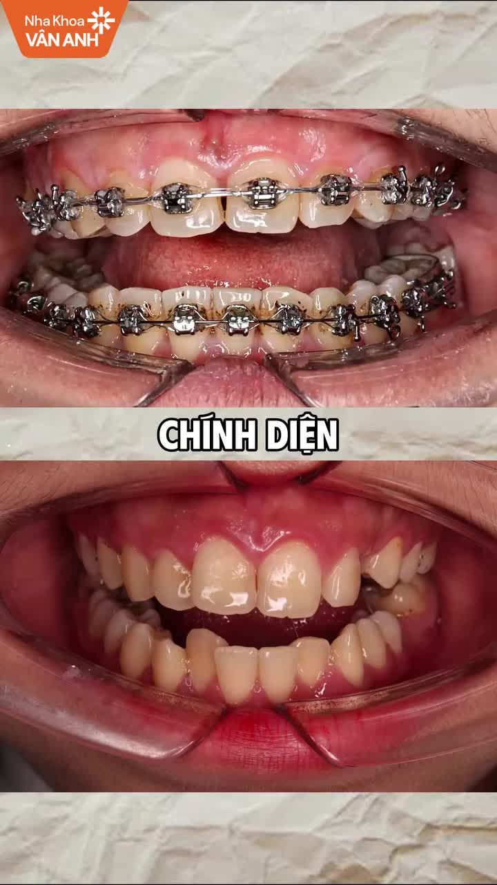 Tình trạng: Răng khấp khểnh hai hàm, sai khớp cắn, lệch đường giữa, cần nhổ răng và kéo lùi để tạo khoảng sắp đều.