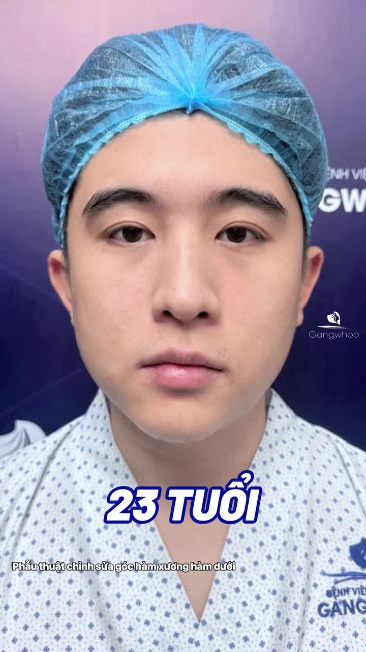 Đang niềng răng thò có gọt hàm được không? Cùng bác sĩ Gangwhoo giải đáp trong video!