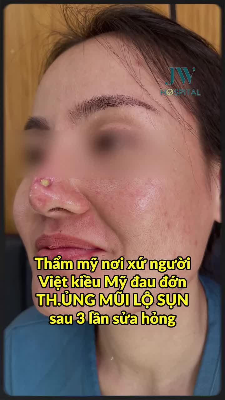 BI KỊCH THẨM MỸ XỨ NGƯỜI: NỮ VIỆT KIỀU MỸ THỦNG MŨI, LỘ SỤN SAU 3 LẦN SỬA HỎNG