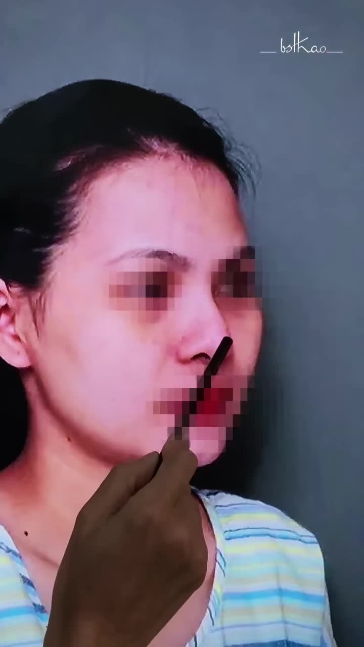 Những vấn đề thường gặp sau nâng mũi Sline cấu trúc?
