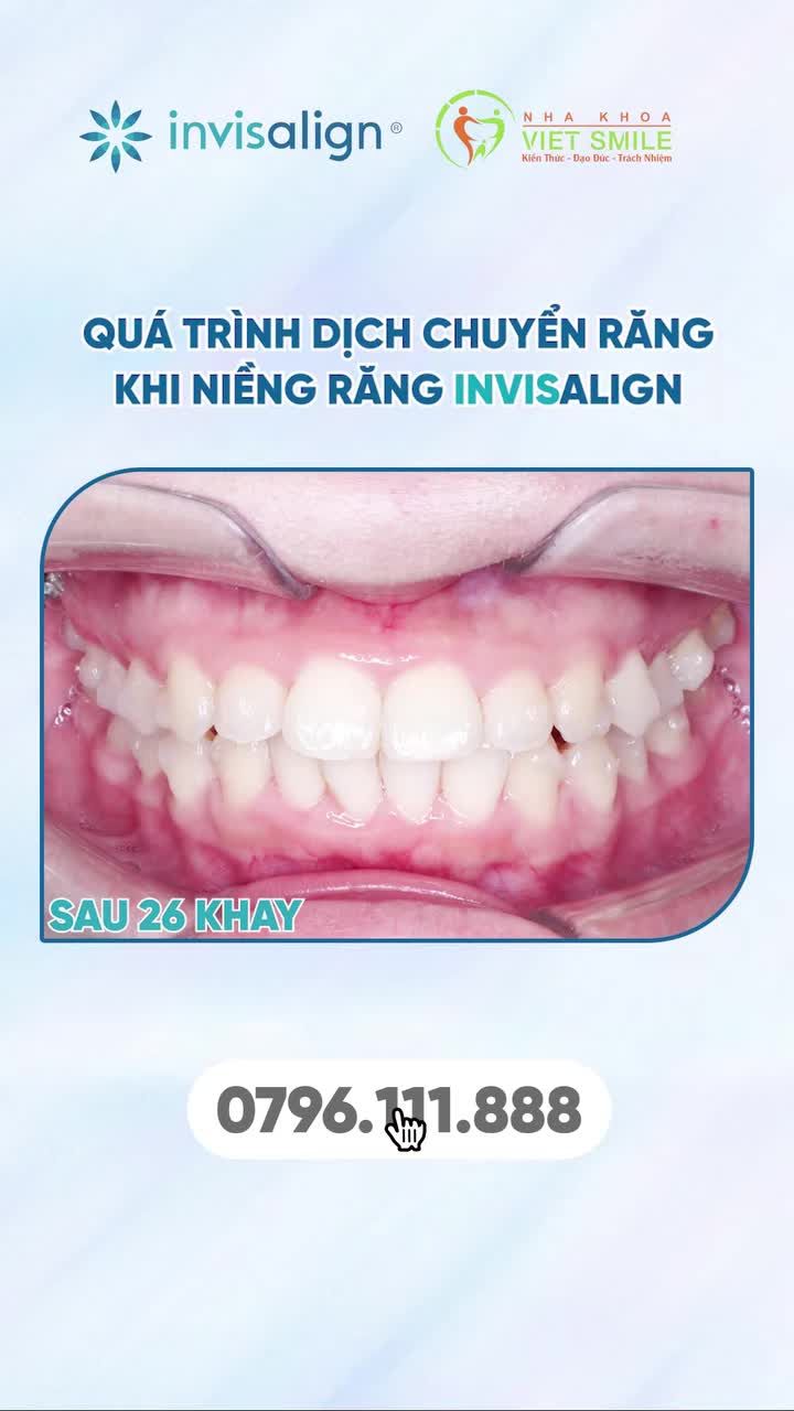 Niềng răng Invisalign sẽ thay đổi như thế nào?