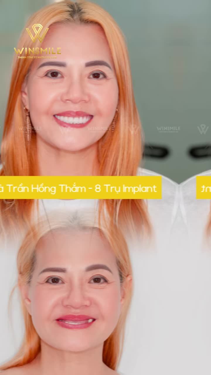 Mất răng cửa, răng hàm hay cả toàn hàm, mỗi tổn thương đều để lại những rào cản trong sinh hoạt và giao tiếp.