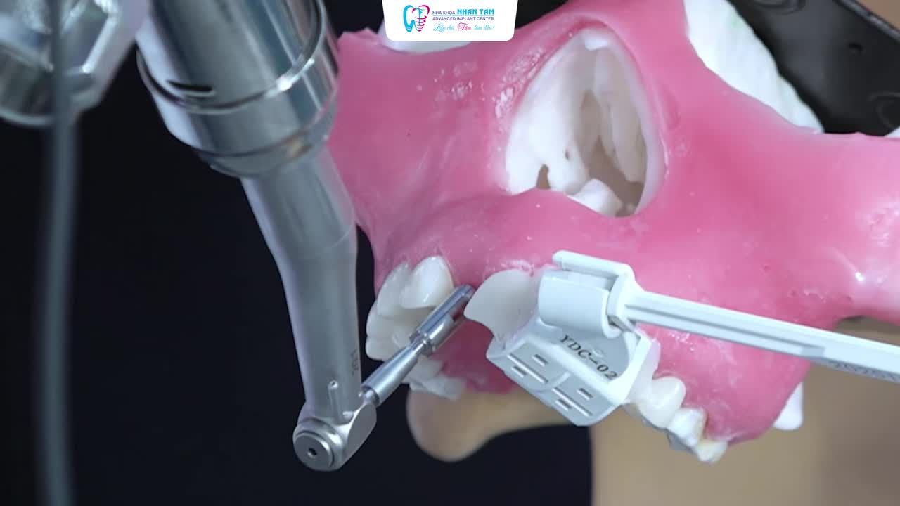 CẤY IMPLANT ĐẾN PHỤC HÌNH TỨC THÌ VỚI ROBOT IMPLANT