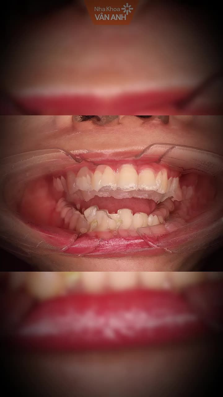 Tình trạng: Răng khấp khểnh hai hàm, sai khớp cắn, hô nhẹ.