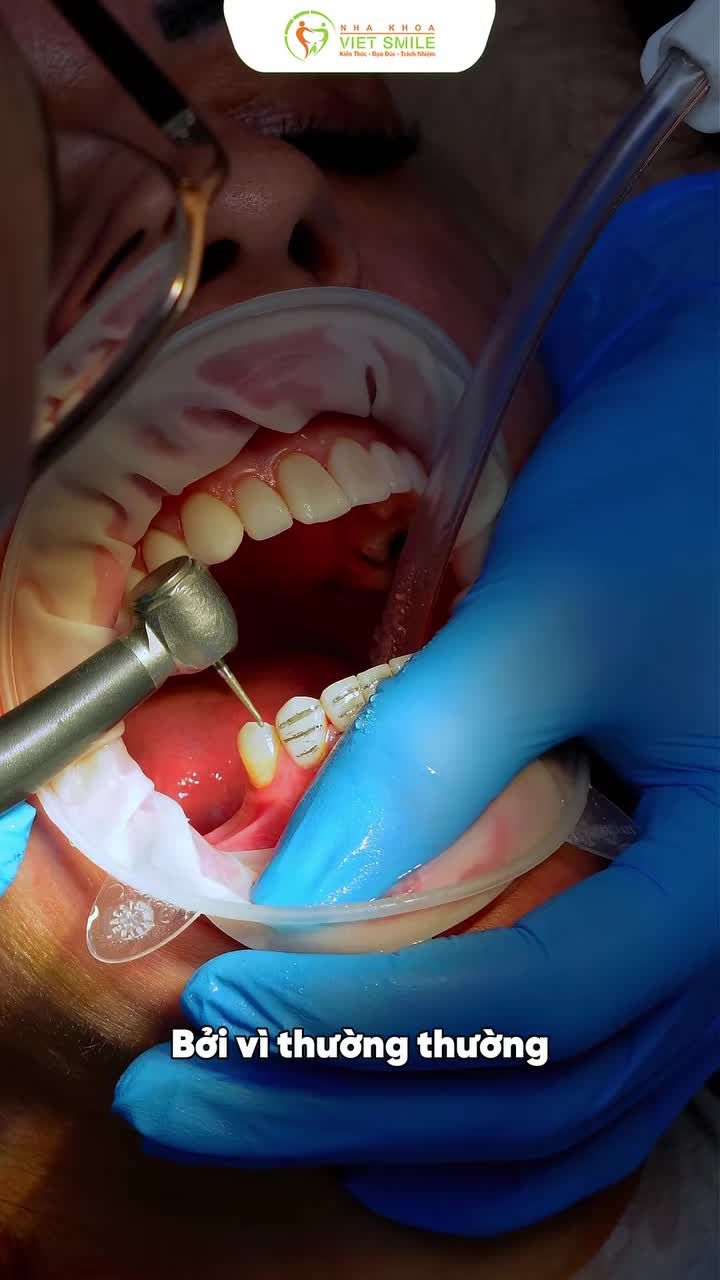 Cách xử lý tụt lợi chân răng