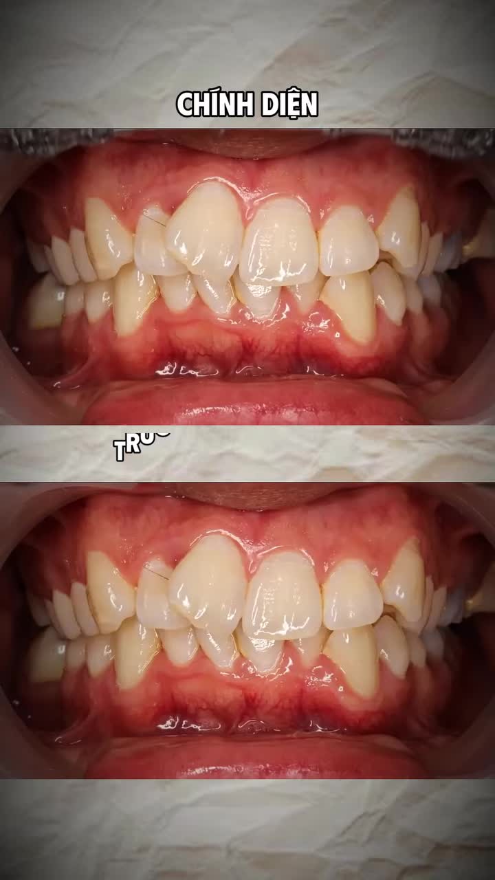 Tình trạng: Răng hô, khấp khểnh nặng, sai khớp cắn.