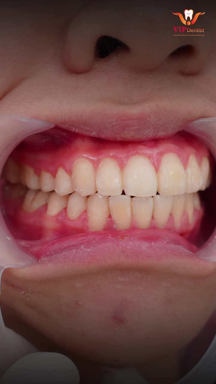 SỰ THAY ĐỔI CỦA HÀM RĂNG NÀY LÀ CẢ 1 HÀNH TRÌNH