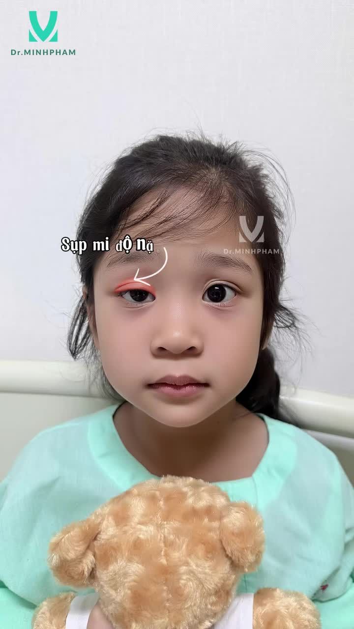 TREO VCT – ĐIỀU TRỊ MẮT SỤP MI