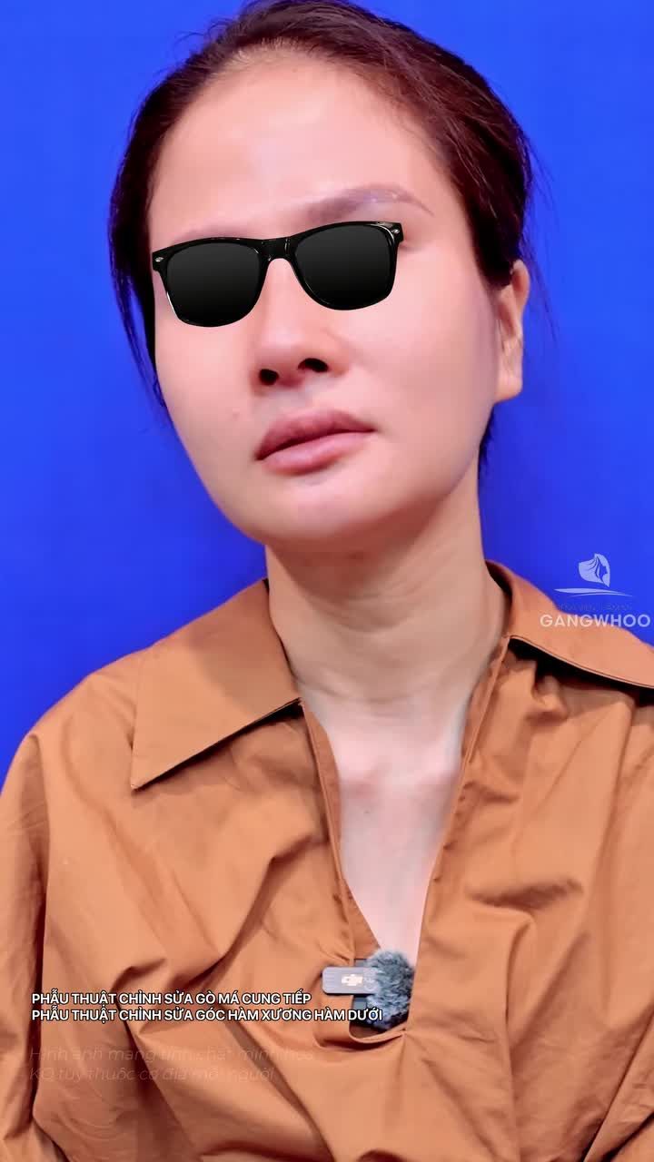 Hơn 1 năm 8 tháng khách hàng cảm nhận như thế nào sau combo gọt hàm hạ gò má có sử dụng nội soi 4K tại Bệnh viện thẩm mỹ Gangwhoo.