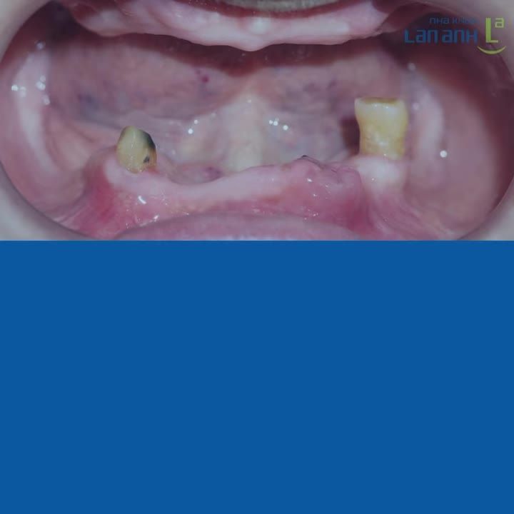 PHỤC HÌNH THÁO LẮP - GIẢI PHÁP PHỤC HỒI NỤ CƯỜI VÀ KHẢ NĂNG ĂN NHAI