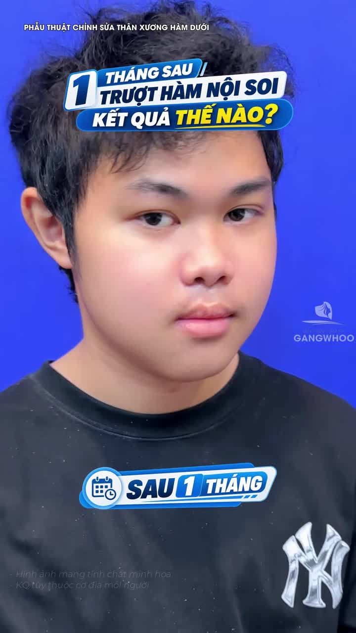 1 tháng sau trượt hàm nội soi 4K kết quả như thế nào? DMKT: Phẫu thuật chỉnh sửa thân xương hàm dưới